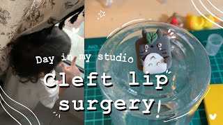 عملت عملية الشفة الأرنبية ل ولدي / عملت كي كابز بالصلصال / cleft lip surgery/ clay art