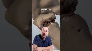 Arthritis Destroying Thumb Joint Shorts