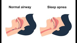 How Sleep Apnea May Relate to NAION?