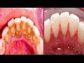THIS NOT A JOKE REMOVE DENTAL PLAQUE IN 2 MINUTES WITHOUT GOING TO THE DENTIST THIS NOT A JOKE REMOVE DENTAL PLAQUE IN 2 MINUTES WITHOUT GOING TO THE DENTIST