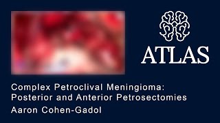 Complex Petroclival Meningioma: Posterior and Anterior Petrosectomies by Aaron Cohen-Gadol