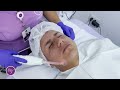 rejuvenecimiento facial con plasma rico en plaquetas