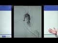 thyroid artery embolization new treatments for enlarged thyroid and thyroid nodules ucla health