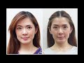 review ปรับรูปหน้าด้วย hifu botox filler ที่ harmony clinic