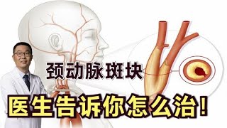 体检发现颈动脉斑块，怎么办？医生说：有2解决办法！