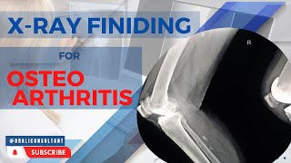 Osteoarthritis Knee X Ray Findings: 1 Best Absolute Guide