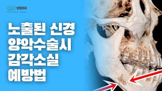 [닥터봉TV_CBK성형외과_최봉균] 안면윤곽수술(사각턱수술)시 노출된 하치조신경 실제 사진 및 양악수술시 감각소실 예방법[CBK整形外科_チェ·ボンギュン]両顎手術時の感覚消失予防法