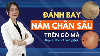 Cách trị NÁM CHÂN SÂU ở GÒ MÁ | Thạc sĩ - Bác sĩ Phương Quý