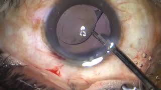 SOFT  CATARACT PSC LIVE STREAM