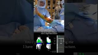 Robotic knee replacement #operatingroom #surgery #arthritistreatment #kneepain