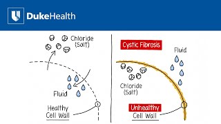 What is Cystic Fibrosis? | Duke Health