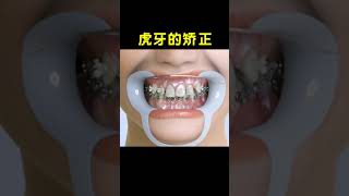 虎牙的矫正 智齿   teeth   wisdom tooth