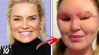 Top 10 Celebrities Who Destroyed Their Faces With Filler