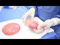 breast implant removal with capsulectomy