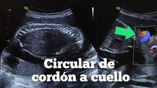 ECOGRAFÍA DE CIRCULAR DE CORDÓN A CUELLO