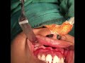 orthognathic surgery intra operative view after downfracture