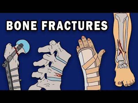 What are the 3 classifications of fractures?