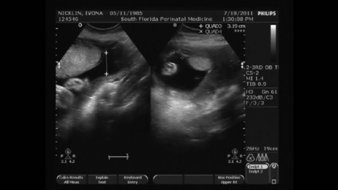 29 Weeks Pregnant 2d Ultrasound