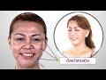 รีวิวดึงหน้า facelift สวยดูดีขึ้นมากหลังทำดึงหน้าเฟซออฟ ทางเลือกที่ปลอดภัย สำหรับการย้อนวัย