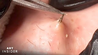 How Ingrown Hairs Are Removed | Art Insider