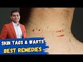 Remove Skin Tags And Warts | Best Home Remedies To Remove Skin Tags And Warts