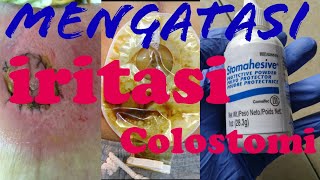 Cara mengatasi iritasi pada colostomy, iritasi kolostomi