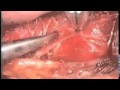 Endoscopic Thyroidectomy