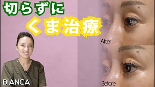 【よくわかる　くま治療(ヒアルロン酸) 症例解説】BIANCA CLINIC