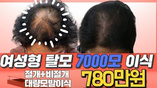 여성 대량모발이식비용 780만원 절개 비절개 혼용 모발이식 전 후