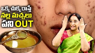 Ramaa Raavi - Skin Care Tips - Simple Home Remedies For Black Spots, Acne and Pimples from Face
