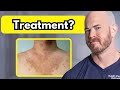 How to Treat Tinea Versicolor | Dr Dustin Portela