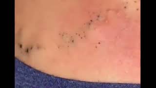 Blackheads Removal Best Pimple Popping Videos