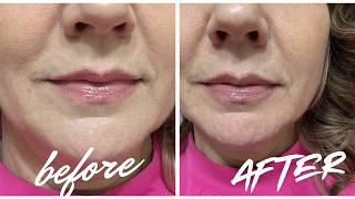 Lip Plumping Treatment for *SENSITIVE LIPS* — Peptides That Actually WORK? LifeCell Review #ad