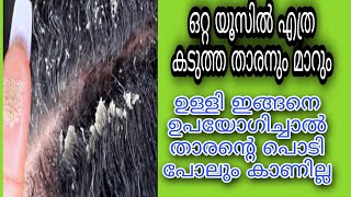 ഒറ്റ ദിവസം കൊണ്ട് മുടികൊഴിച്ചിലും എത്ര കടുത്ത താരനും മാറാനുള്ള കിടിലൻ ഒറ്റമൂലി ||Remove Dandruff