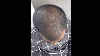 Minoxidil 5% using 8 month hair growth results
