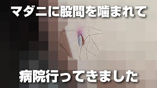 【閲覧注意】マダニに股間噛まれて1週間放置してたら病院行きに・・