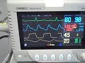 anesthetic monitoring video