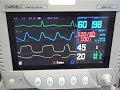 anesthetic monitoring video