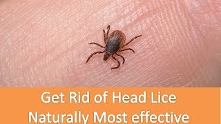 Lice Causes And Get Rid of Lice Naturally Best Home Remedies for Removing Lice