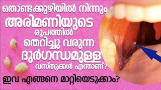 തൊണ്ടയില്‍ നിന്നും ദുര്‍ഗന്ധത്തോടെ അരിമണി പോലെ തികട്ടി വരുന്നത് എന്താണ്? What Are Tonsil Stones ?