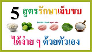 5 สูตรรักษาเล็บขบด้วยตัวเอง