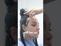 نتيجة تصغير الجبهة بزراعة الشعر تصغير الجبهة بعد 6 أشهر تجربتي مع زراعة الشعر