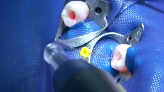 Root canal disinfection with SIROLaser Blue