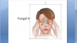 ENT Fungal Sinusitis Fungus infection sinus Ball Allergic Chronic Fulminant