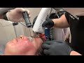 I HAVE FACIAL REDNESS | CLEAR MY ACNE AND ROSACEA WITH MOXI LASER SKIN RESURFACING | Dr. Jason Emer