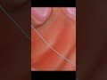 insertion of iud intrauterine device to prevent pregnancy birth control 4k animation asmr