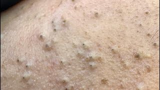 Say Goodbye to Pimples & Blackheads | Ultimate Deep Cleansing Facial Care Routine