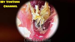 Ear Wax Removal #183: |ear wax removal | ear cleaning | ASMR | relaxation | relax