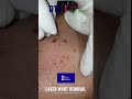 Laser Wart Removal