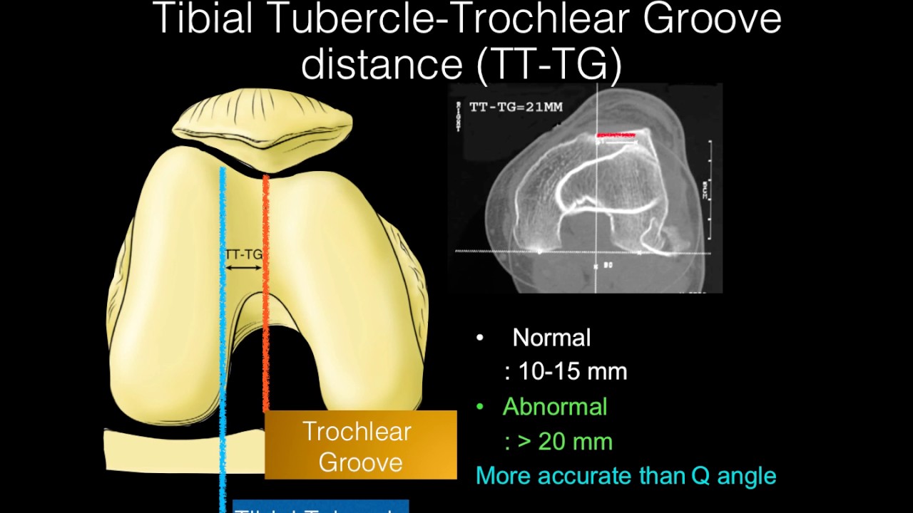 Recurrent Patellar Dislocation - YouTube